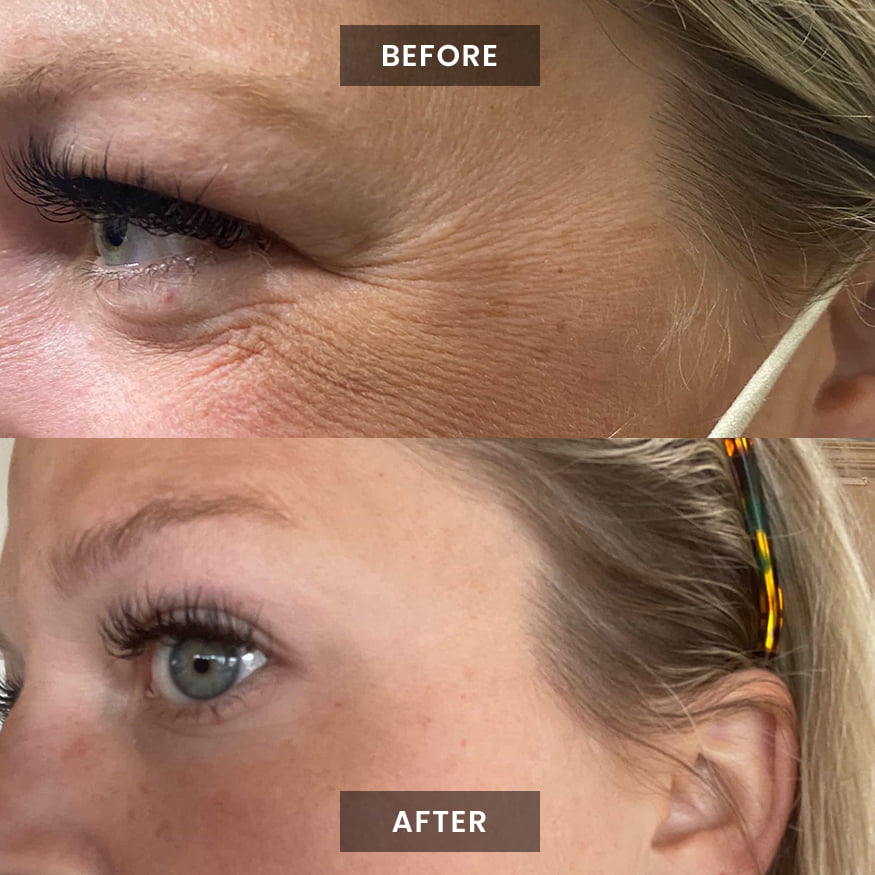puretox-before-after-1